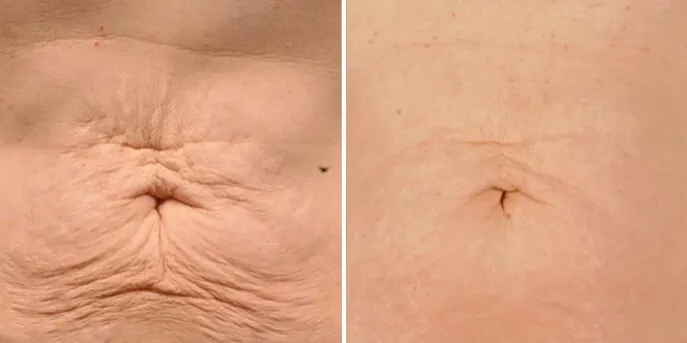 Before and after Body Skin Tightening, photo 2