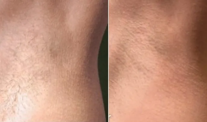 Before and after laser hair removal, photo 3