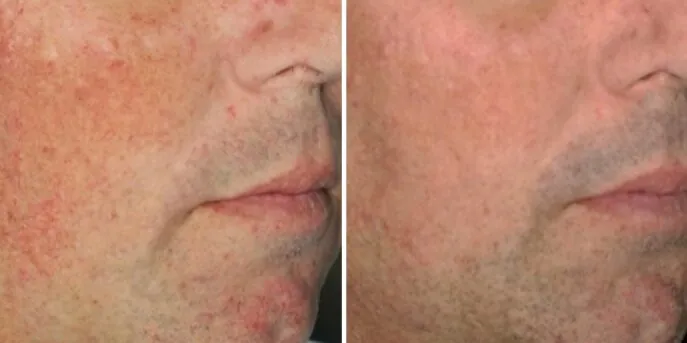 Before and after 3D Skin Rejuvenation, photo 3