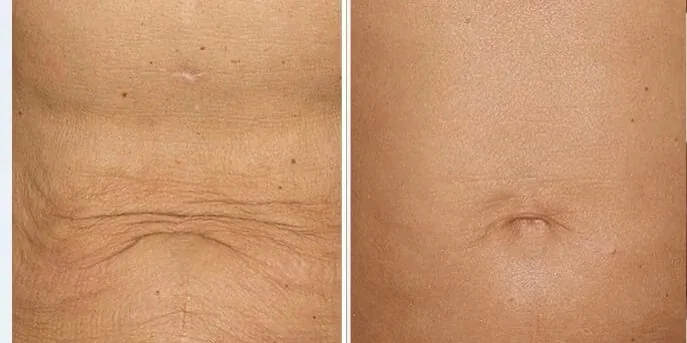 Before and after Titan Skin Tightening, photo 1