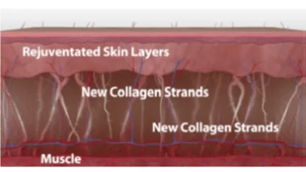 Body Skin Tightening: illustration 3