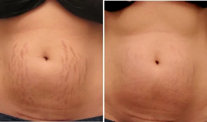 Before and after Laser Stretch Mark Removal, photo 2