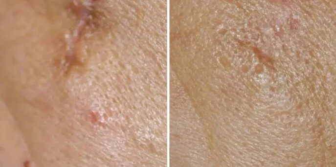 Before and after Scar Removal, photo 2