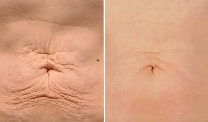 Before and after Thermage FLX, photo 1