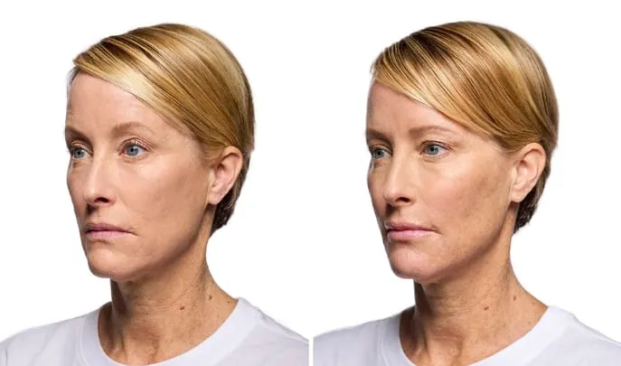Before and after Dermal Fillers, photo 3