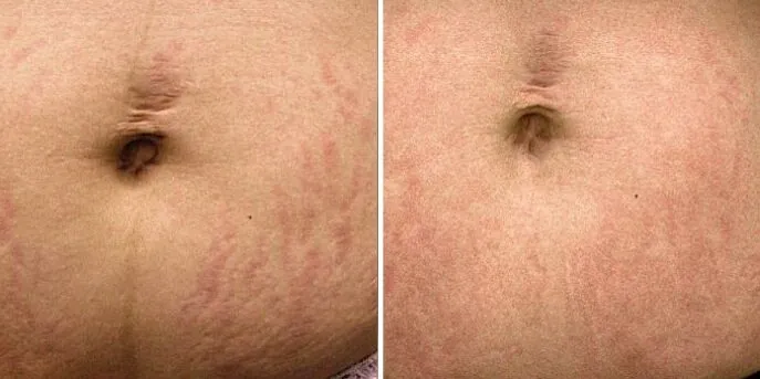 Before and after Stretch Mark Treatments, photo 1