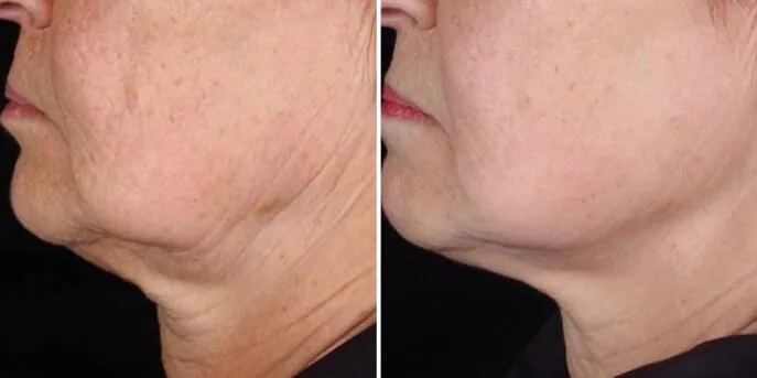 Before and after Titan Skin Tightening, photo 3