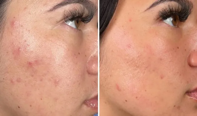 Before and after Hydrafacial, photo 1