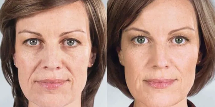 Before and after Sculptra, photo 1