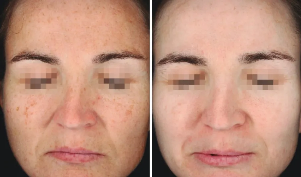 Before and after Dermamelan, photo 1