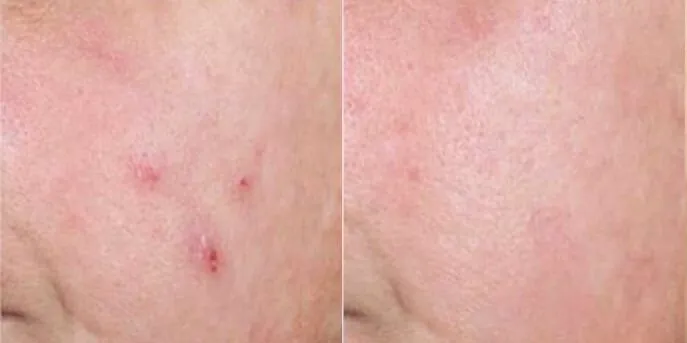 Before and after Acne Treatments, photo 3