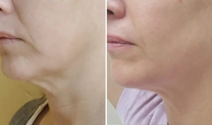 Before and after Forma Skin Tightening, photo 3