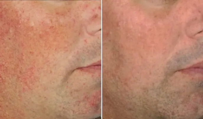 Before and after Laser Spider Vein Removal, photo 1