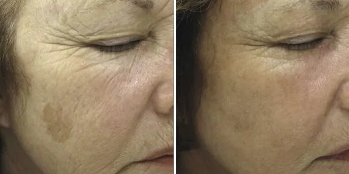 Before and after Pigmentation Treatments, photo 2