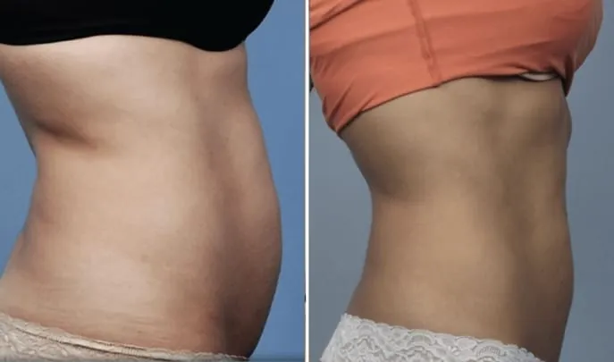 Before and after Evolve Transform, photo 3