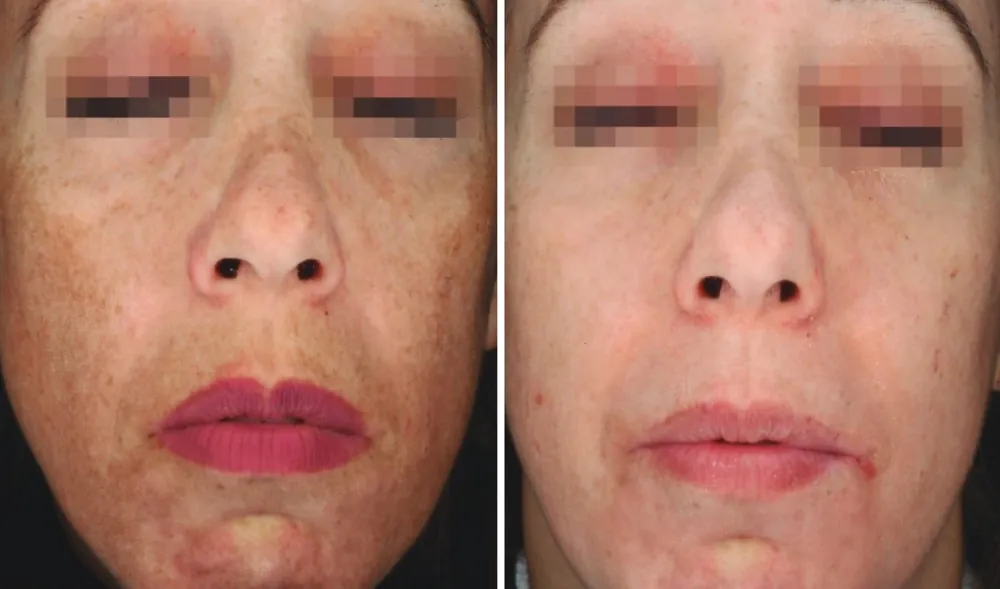 Before and after Dermamelan, photo 3