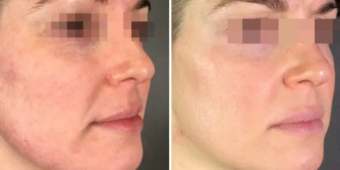 Before and after 3D Skin Rejuvenation, photo 1