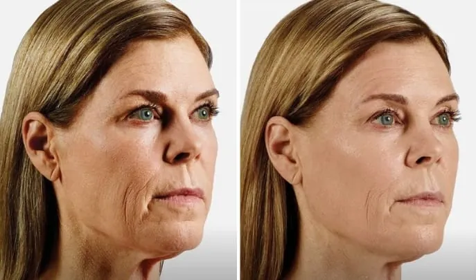 Before and after Dermal Fillers, photo 2