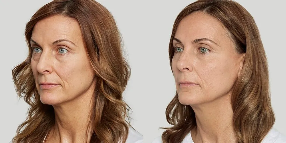 Before and after Sculptra, photo 3