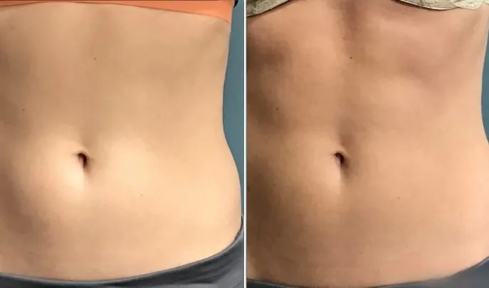 Before and after Evolve Transform, photo 1