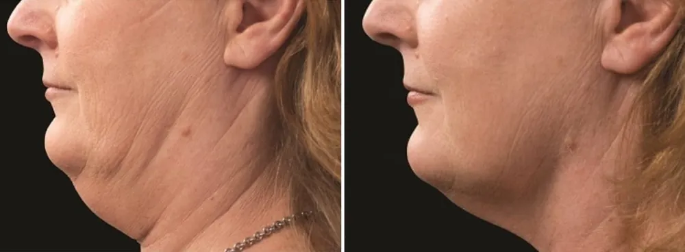 Before and after CoolSculpting for Double Chin, photo 2