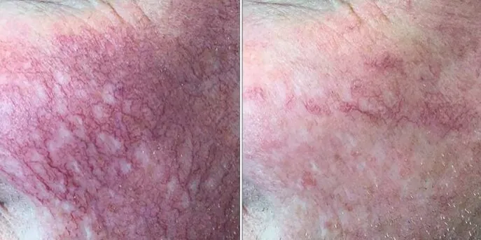 Before and after Rosacea & Redness Treatments, photo 1
