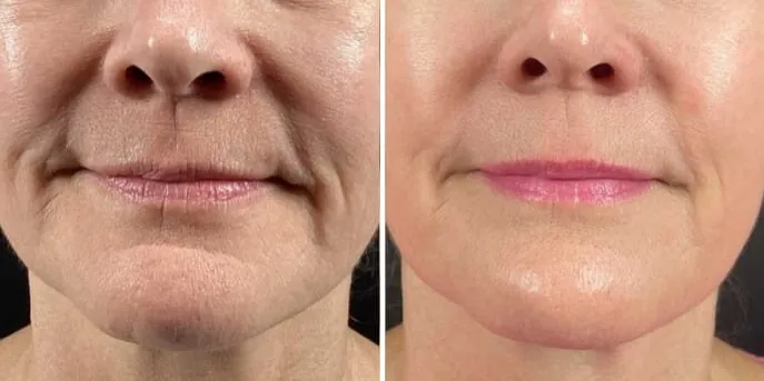 Before and after Microneedling, photo 2