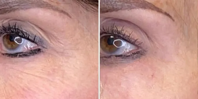 Before and after Morpheus8, photo 1