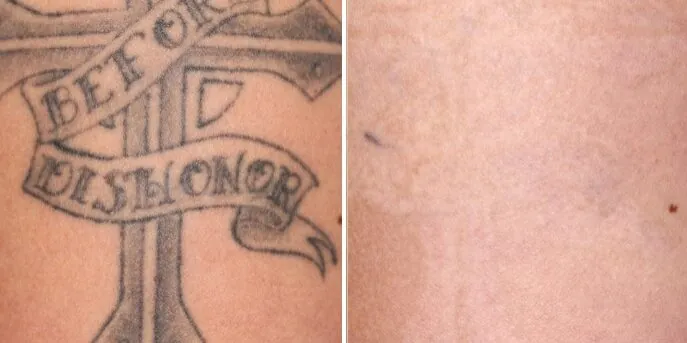Before and after PicoSure Tattoo Removal, photo 1