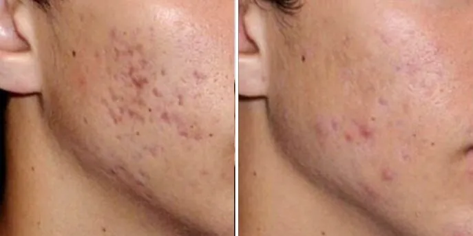 Before and after Scar Removal, photo 3