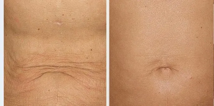 Before and after Body Skin Tightening, photo 1