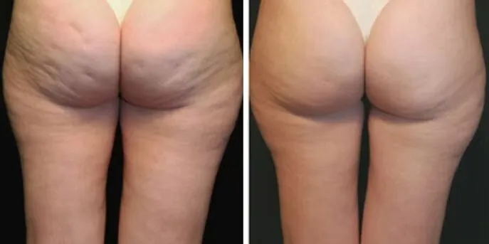 Before and after Thermage for Cellulite, photo 1