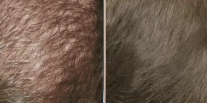 Before and after Hair Loss Treatments, photo 1