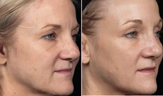 Before and after Thermage FLX, photo 2