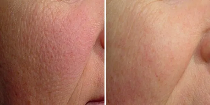 Before and after Rosacea & Redness Treatments, photo 3