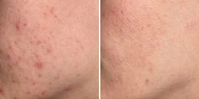 Before and after Acne Treatments, photo 1