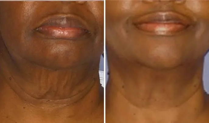 Before and after Forma Skin Tightening, photo 2