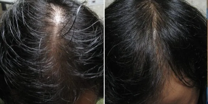 Before and after Liquid Formula Hair Restoration, photo 2