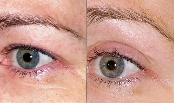 Before and after Thermage FLX, photo 3