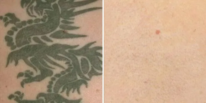 Before and after PicoSure Tattoo Removal, photo 3