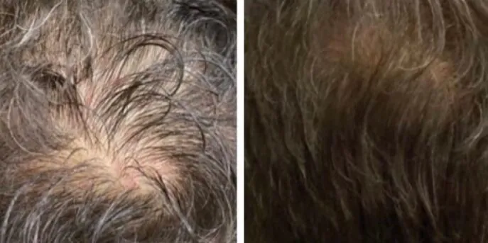 Before and after Pluryal Injections, photo 2