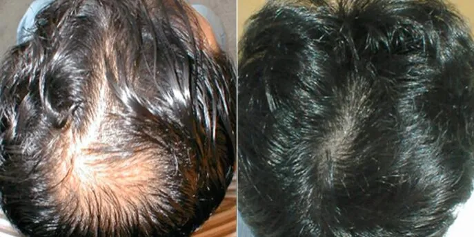 Before and after Liquid Formula Hair Restoration, photo 1