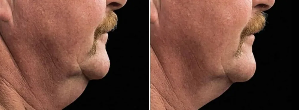 Before and after CoolSculpting for Double Chin, photo 3