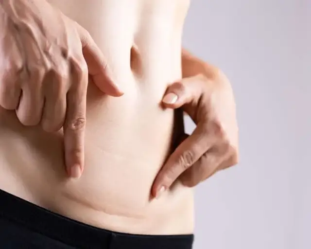 Carboxytherapy for Scars
