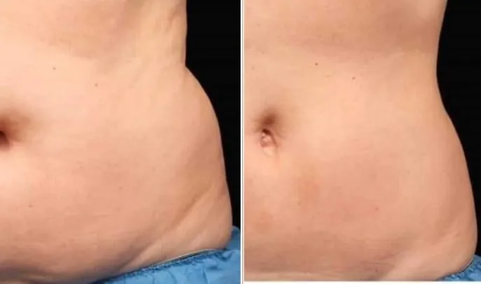 Before and after CoolSculpting, photo 1