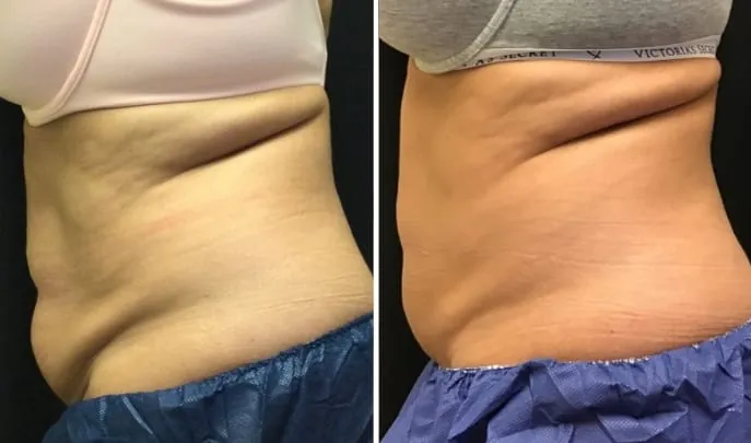 Before and after CoolSculpting, photo 2