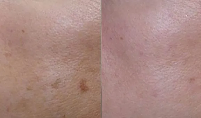 Before and after IPL Photorejuvenation, photo 2