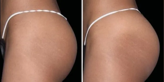 Before and after Emsculpt Neo, photo 3