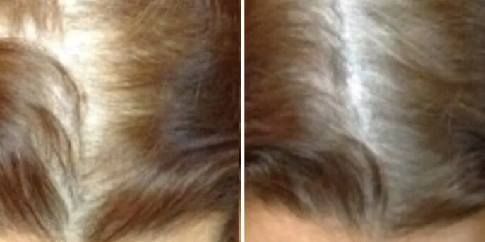 Before and after Laser Hair Loss Treatment, photo 2