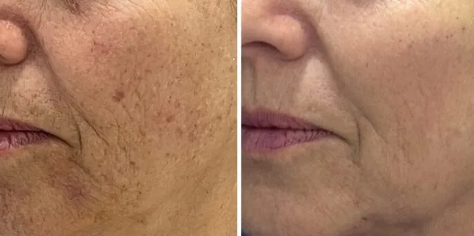 Before and after 3D Skin Rejuvenation, photo 2